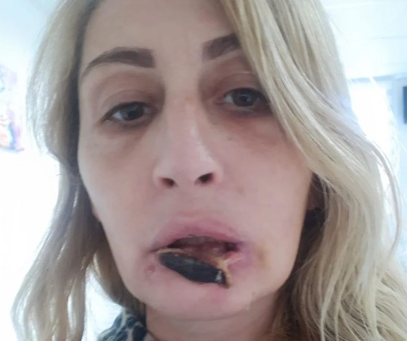 Foto - Batılı yaşam tarzının son eseri: Güzellik uğruna dudağından oldu!