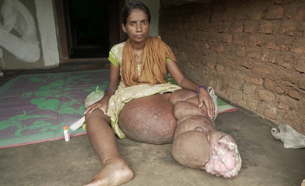 Foto - Bazılarının elleri ağaç oluyor, bazılarının bütün vücudu tüylerle kaplanıyor! İşte dünyadaki en garip hastalıklarI