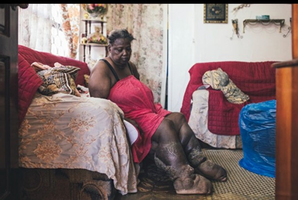 Foto - Bazılarının elleri ağaç oluyor, bazılarının bütün vücudu tüylerle kaplanıyor! İşte dünyadaki en garip hastalıklarI