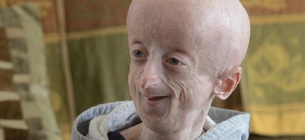 Foto - Bazılarının elleri ağaç oluyor, bazılarının bütün vücudu tüylerle kaplanıyor! İşte dünyadaki en garip hastalıklarI