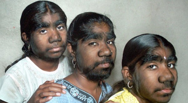 Foto - Bazılarının elleri ağaç oluyor, bazılarının bütün vücudu tüylerle kaplanıyor! İşte dünyadaki en garip hastalıklarI