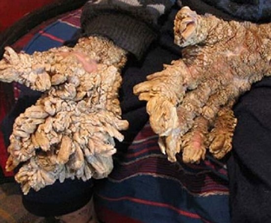 Foto - Bazılarının elleri ağaç oluyor, bazılarının bütün vücudu tüylerle kaplanıyor! İşte dünyadaki en garip hastalıklarI