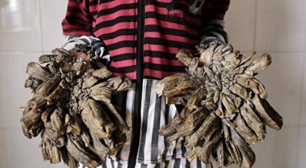 Bazılarının elleri ağaç oluyor, bazılarının bütün vücudu tüylerle kaplanıyor! İşte dünyadaki en garip hastalıklarI