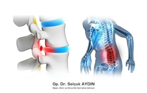 Foto - Bel fıtığı hakkında doğru sanılan 10 yanlış!