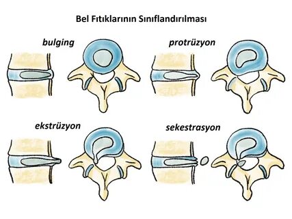 Foto - Bel fıtığı hakkında doğru sanılan 10 yanlış!