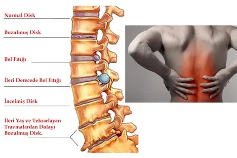 Foto - Bel fıtığı hakkında doğru sanılan 9 yanlış bilgi!