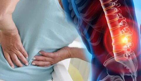 Foto - Bel fıtığı hakkında doğru sanılan 9 yanlış bilgi!