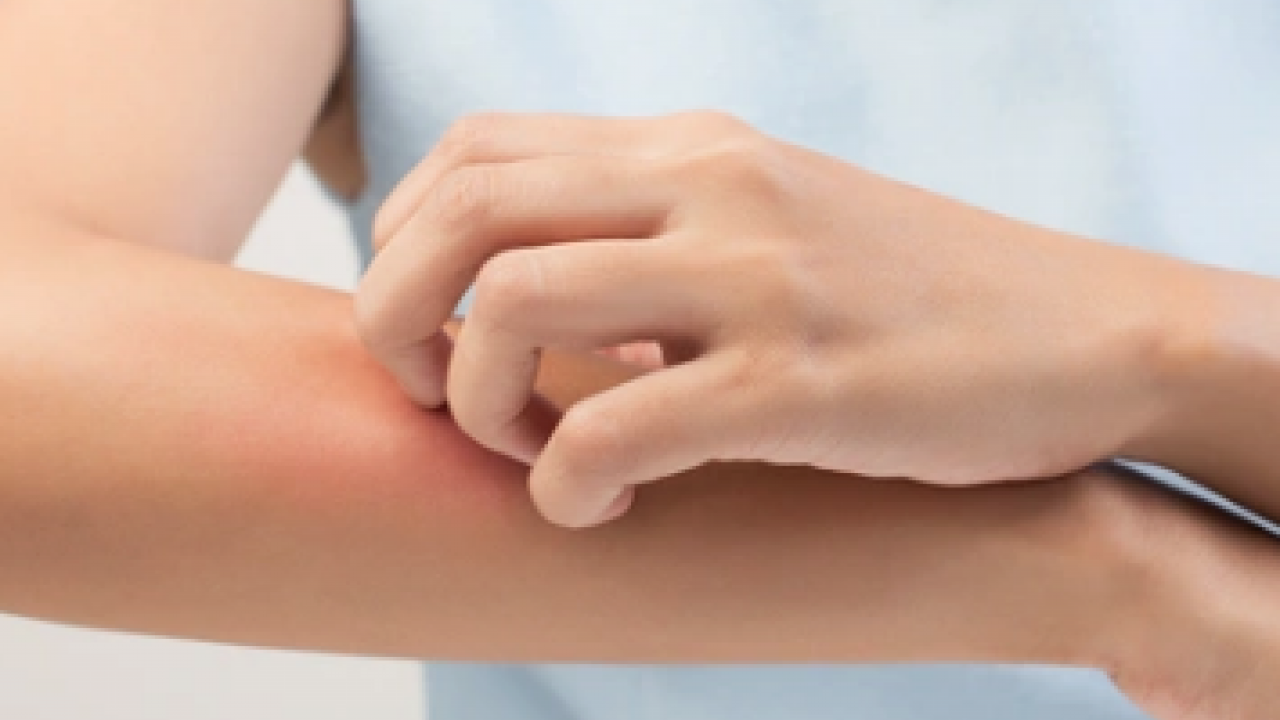 Belli oldu! Bu yöntemle kaşıntı tarih olacak! Şok eden rahatsızlık sona erecek...