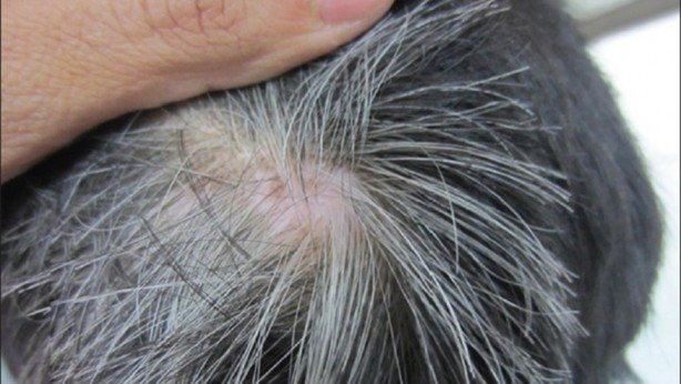 Foto - Beyaz saçlara veda ettiren kür