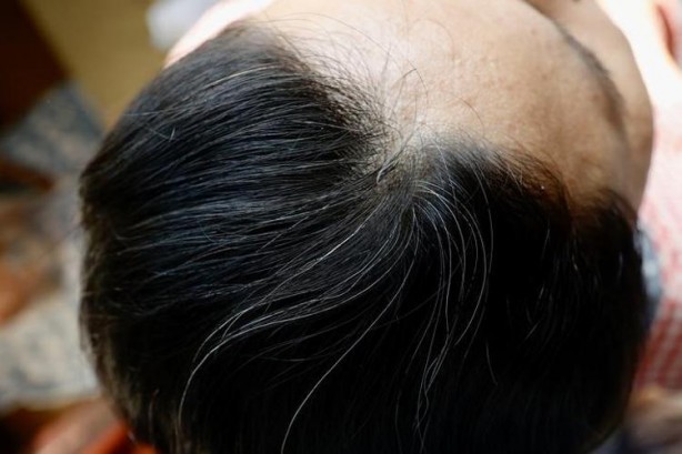 Foto - Beyaz saçlardan kurtulmanın en doğal yolu! 1 saat bekletin olanları görünce şaşıracaksınız