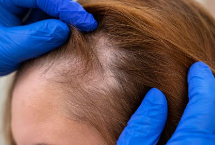 Foto - Beyaz saçları yok eden saç dökülmesini durduran bitkisel kür: Saçlarınız kökünden fışkıracak!