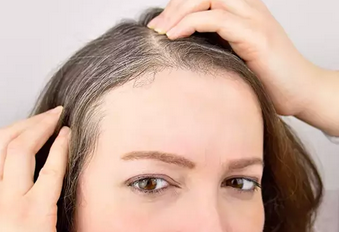 Foto - Beyazlayan saçları tamamen doğal yolla eski haline döndürmek: İlaçlara taş çıkartacak! Anında kapatan kür!