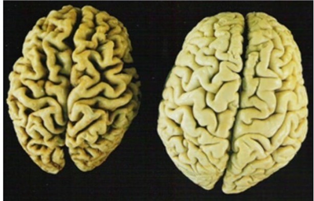 Foto - Beyin hakkındaki ilginç gerçekler!