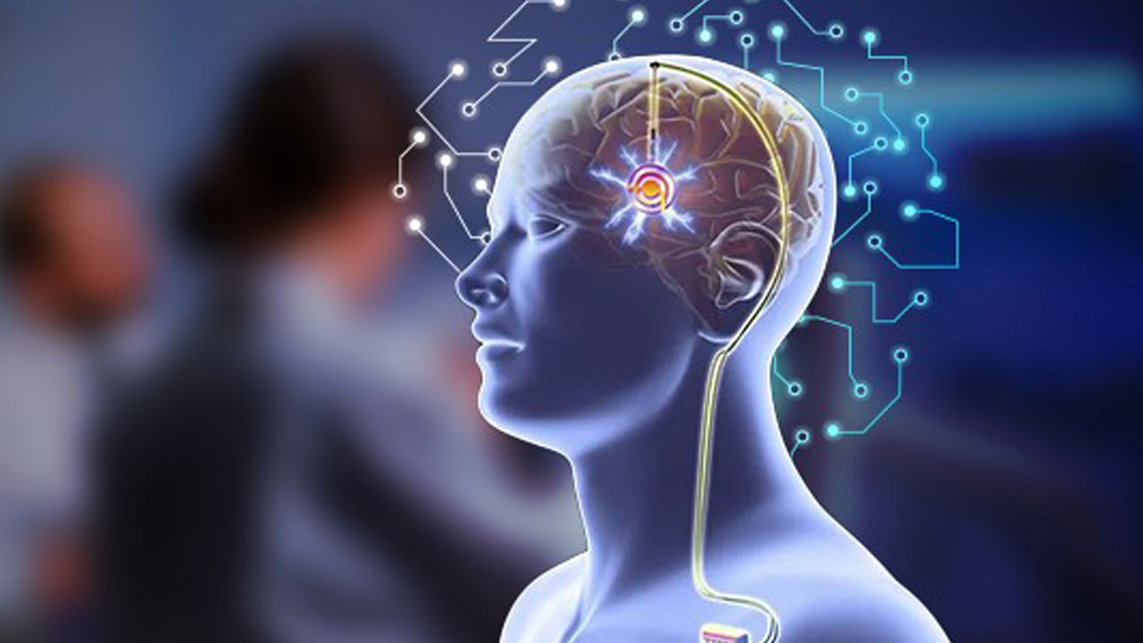 Foto - Beyne elektrotlar yerleştiriliyor! Hastalık bu yöntemle kontrol altına alınıyor