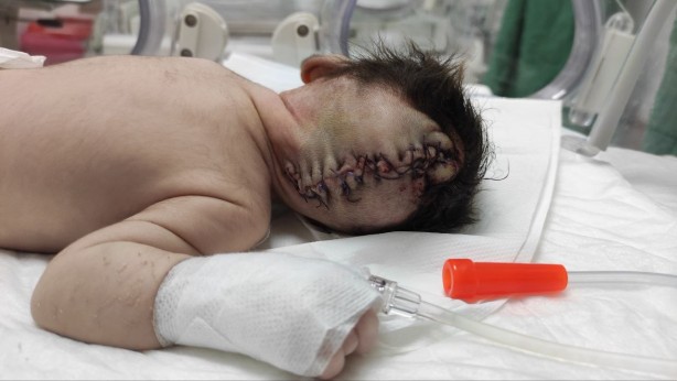 Foto - Beyninin yarısı kafatası dışında dünyaya geldi