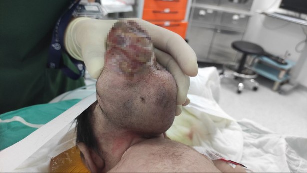 Foto - Beyninin yarısı kafatası dışında dünyaya geldi