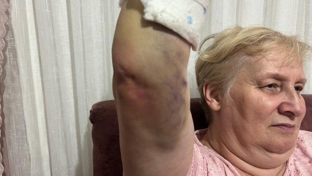 Foto - Bileği kırılan yaşlı kadına özel hastaneden akılalmaz fatura! 'Bu kadar da olmaz' dedirtti