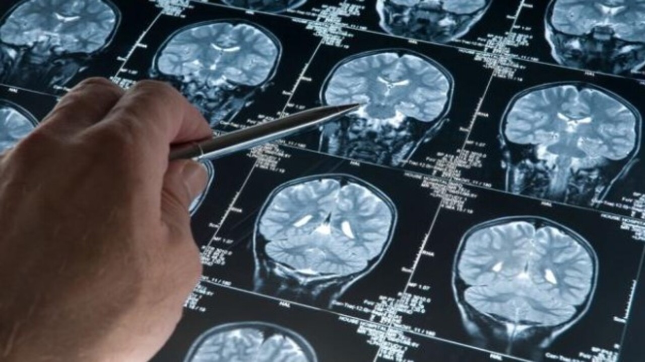 Bilim adamları ezber bozdu! Alzheimer babadan mı geçiyor