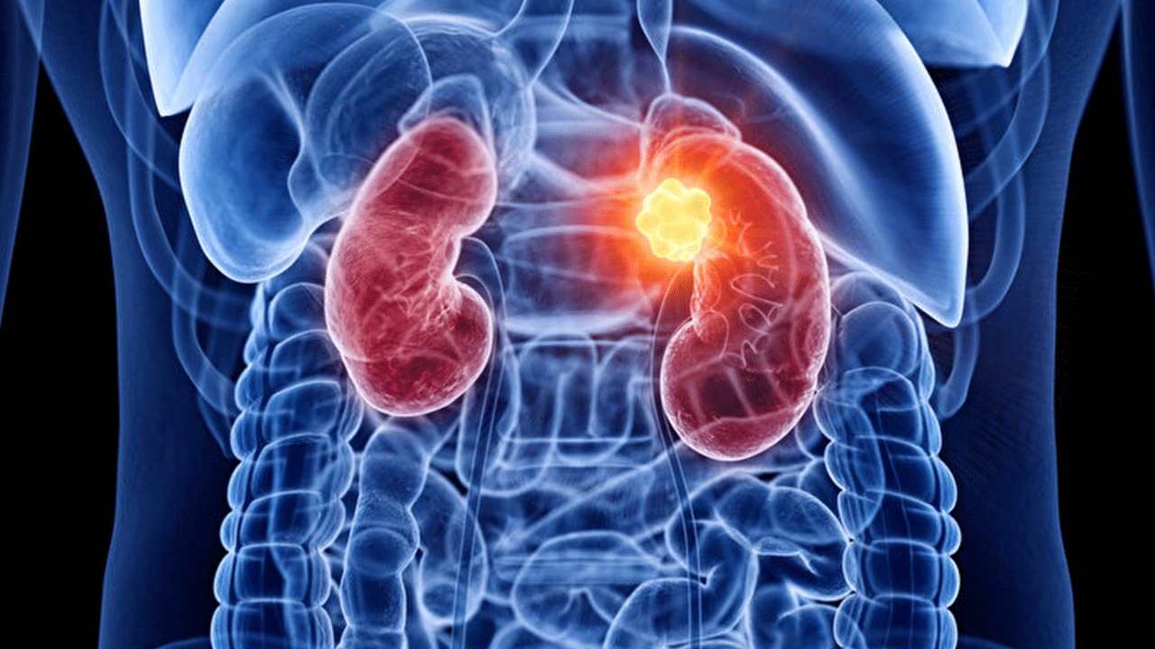 Foto - Bilim adamları hepsi iyileşti diyerek duyurdu: Kanseri yok ettiler!