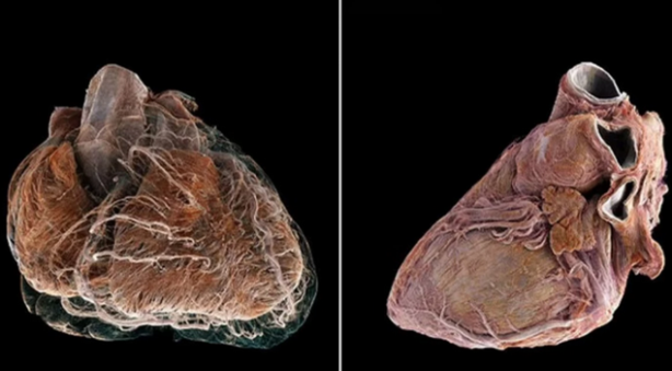 Foto - Bilim insanları, insan kalbinin iç yapısını ayrıntılı olarak gösteren, Google Earth'e benzer yeni bir teknoloji geliştirdi 