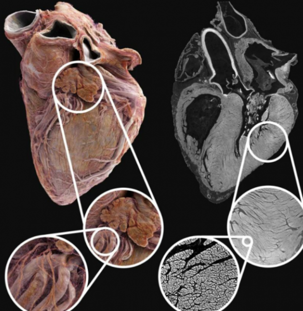 Foto - Bilim insanları, insan kalbinin iç yapısını ayrıntılı olarak gösteren, Google Earth'e benzer yeni bir teknoloji geliştirdi 