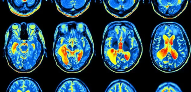 Foto - Bir ay boyunca hamburger ekmek yerseniz bakın ne oluyor! İngiliz doktor denedi... Şok oldu