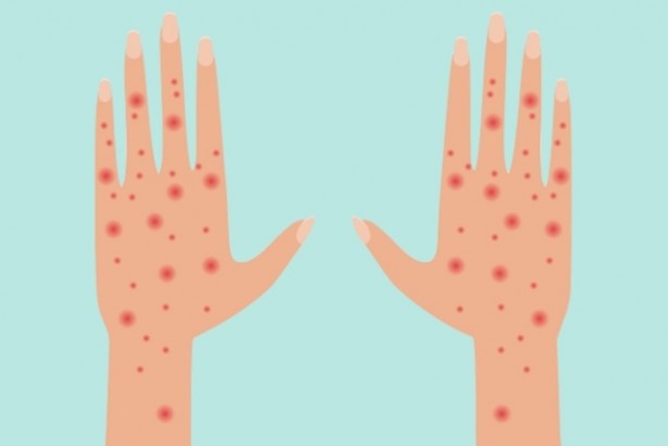 Foto - Bir bu eksikti! Uyuz ile ilgili korkutan sözler