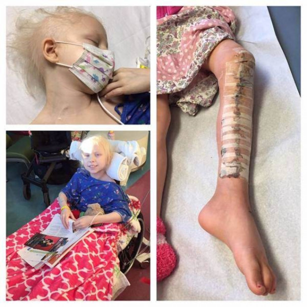 Foto - Bir gece ansızın bacağı ağrımaya başladı ve teşhis konuldu! Kanser!