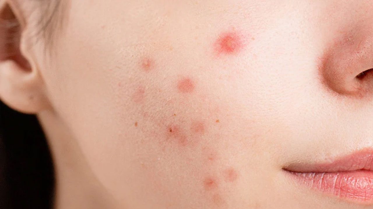 Bir günde cildiniz bebek gibi olacak! Sürekli tekrar çıkan sivilcelere sağlıklı çözüm