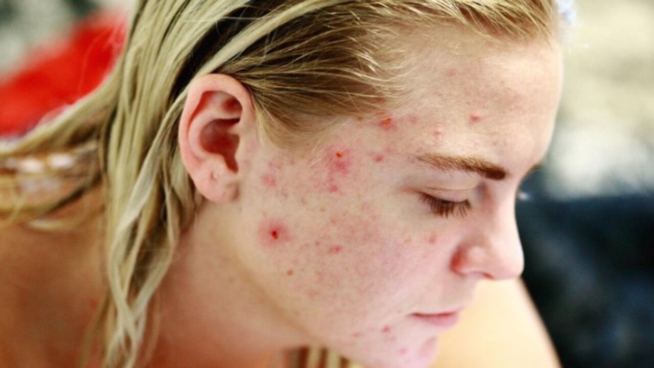 Foto - Bir günde cildiniz bebek gibi olacak! Sürekli tekrar çıkan sivilcelere sağlıklı çözüm