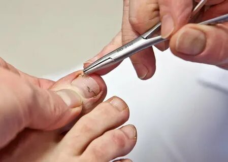 Foto - Birçok kişinin başına geliyor İşte tırnak batmasını önlemenin 5 yolu!