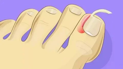 Foto - Birçok kişinin başına geliyor İşte tırnak batmasını önlemenin 5 yolu!