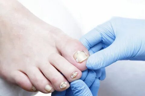 Foto - Birçok kişinin başına geliyor İşte tırnak batmasını önlemenin 5 yolu!