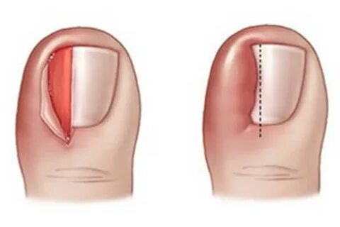 Foto - Birçok kişinin başına geliyor İşte tırnak batmasını önlemenin 5 yolu!