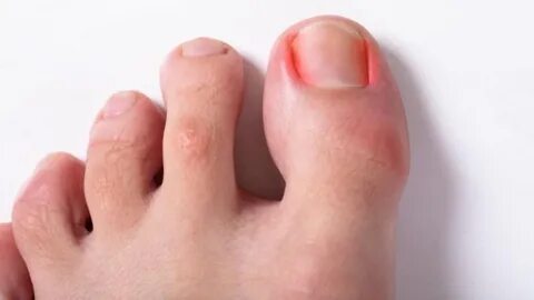Foto - Birçok kişinin başına geliyor İşte tırnak batmasını önlemenin 5 yolu!