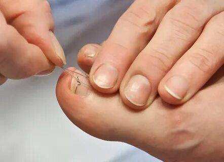 Birçok kişinin başına geliyor İşte tırnak batmasını önlemenin 5 yolu!