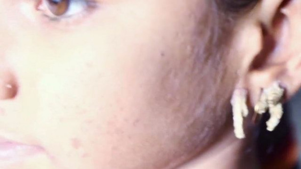 Foto - Birden yüzünde çıkmaya başladılar!