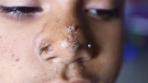 Foto - Birden yüzünde çıkmaya başladılar!