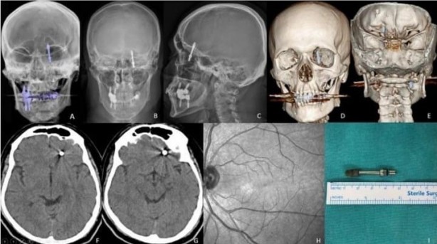 Biz kime güveneceğiz! Bursa'da inanılmaz olay yaşandı! İmplant tedavisinde vida beynine saplandı! Amerika'da dergilere konu oldu!