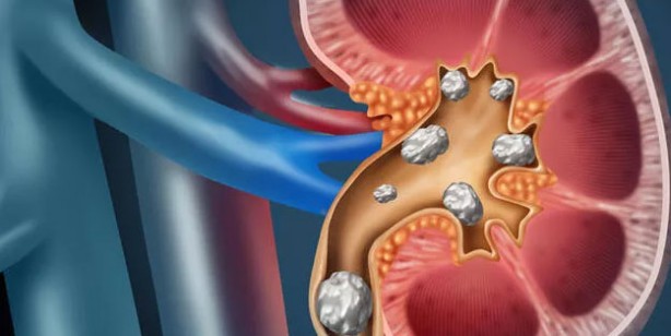Foto - Böbrek sağlığına iyi gelen içecek ve besinler