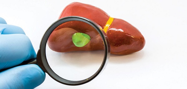 Foto - Böbrek taşı olanlar dikkat! Kesinlikle bunu ihmal etmeyin