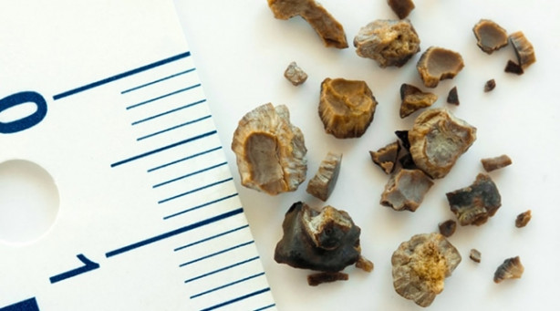 Foto - Böbrek taşı tedavisinde bu yanlışlara düşmeyin!