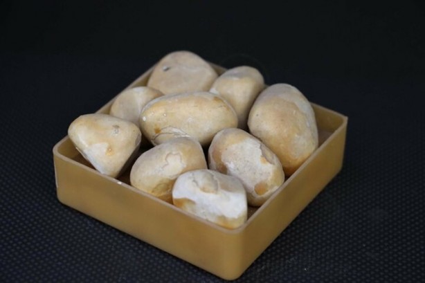 Foto - Böbreklerden çıkan taşlar görenleri hayrete düşürüyor!