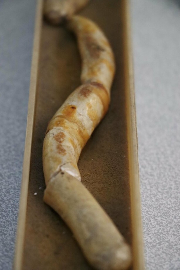 Foto - Böbreklerden çıkan taşlar görenleri hayrete düşürüyor!