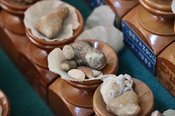 Foto - Böbreklerden çıkan taşlar görenleri hayrete düşürüyor!