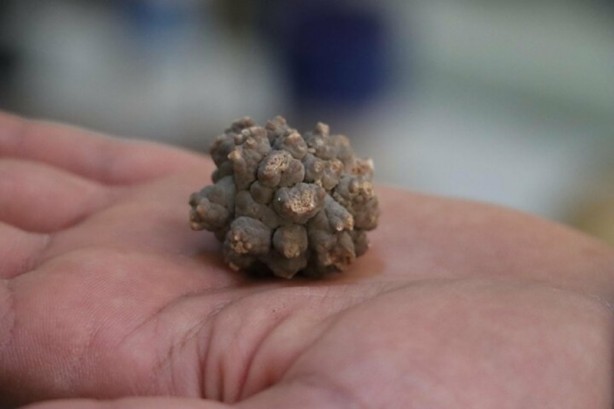 Foto - Böbreklerden çıkan taşlar görenleri hayrete düşürüyor!