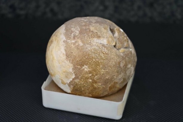 Foto - Böbreklerden çıkan taşlar görenleri hayrete düşürüyor!