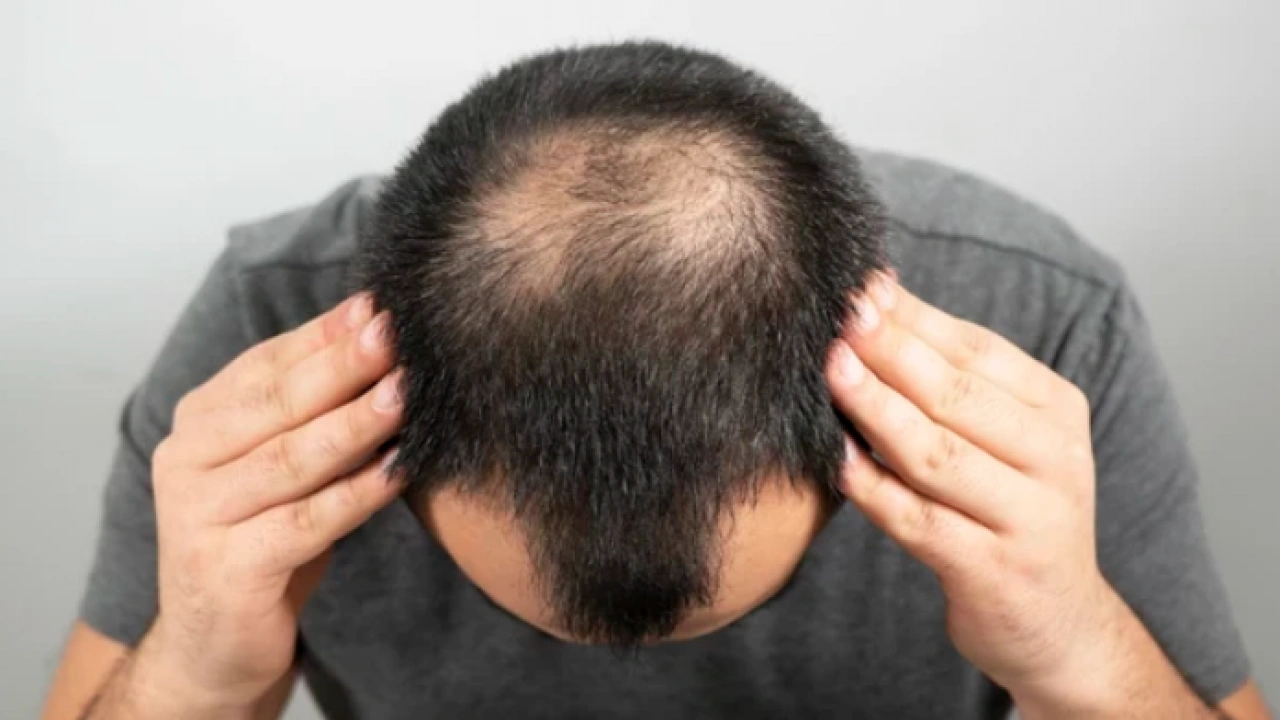 Foto - Bölgesel kellik diyabetin habercisi mi? Kellik deyip geçmemek lazım yoksa…