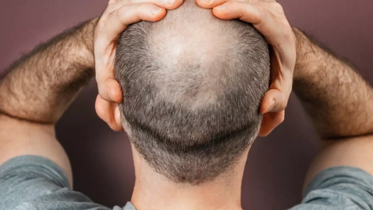 Foto - Bölgesel kellik diyabetin habercisi mi? Kellik deyip geçmemek lazım yoksa…