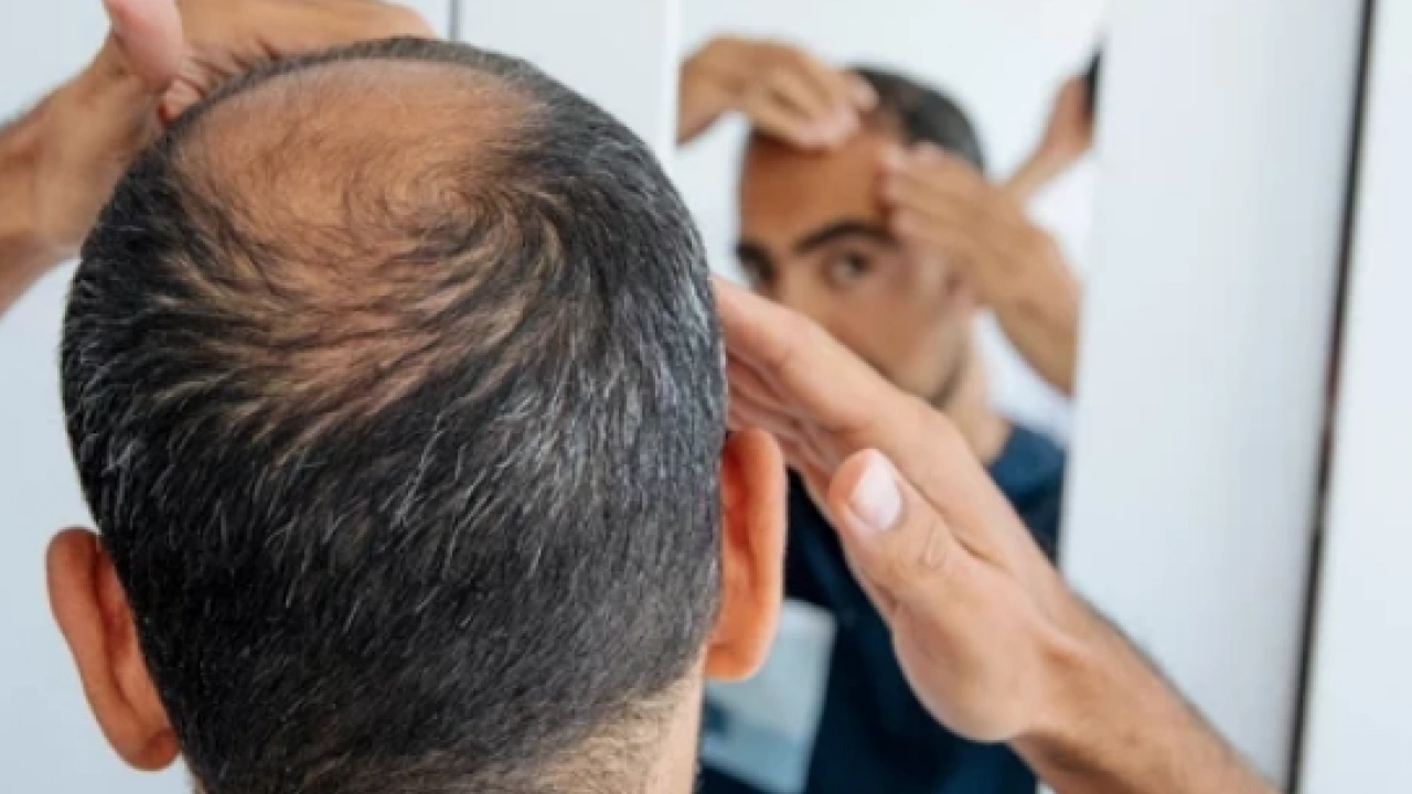 Foto - Bölgesel kellik diyabetin habercisi mi? Kellik deyip geçmemek lazım yoksa…